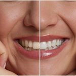 teeth whitening in federal way